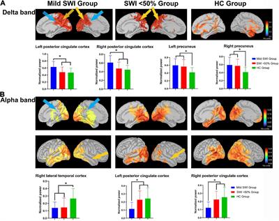 Alterations in the default mode network in rolandic epilepsy with mild spike-wave index in non-rapid eye movement sleep